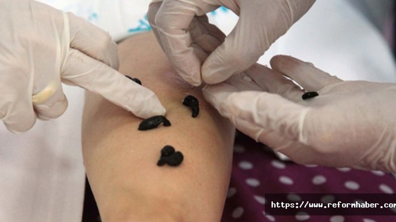 Sülük tedavisi nedir, nasıl yapılır? Sülük tedavisi faydaları nelerdir? Sülük tedavisi hakkında bilgiler..