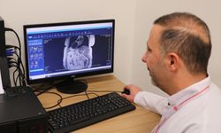 İç organları ters olan hastanın safra kesesindeki taş ERCP işlemiyle alındı