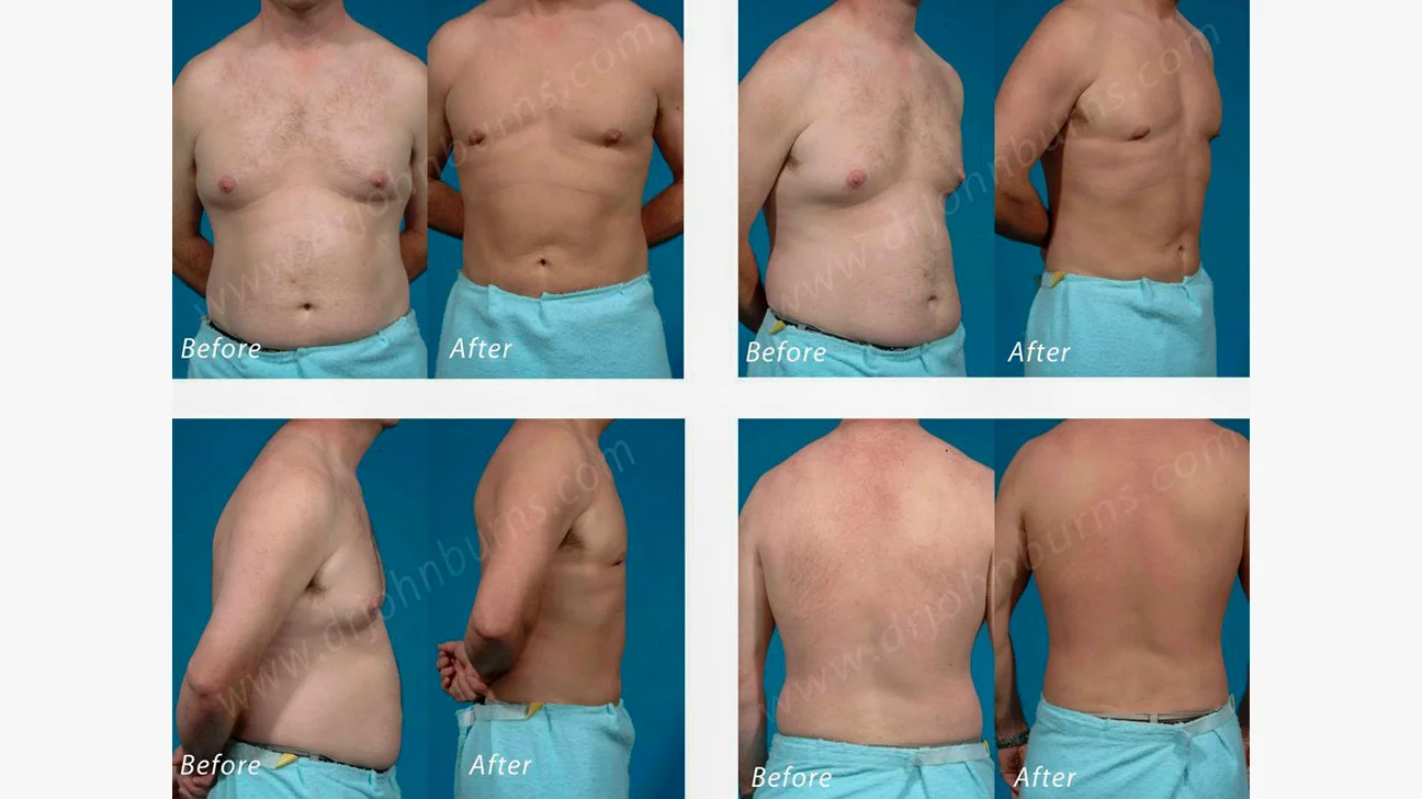Tumescent Liposuction Before And After 1296X728 Slide1